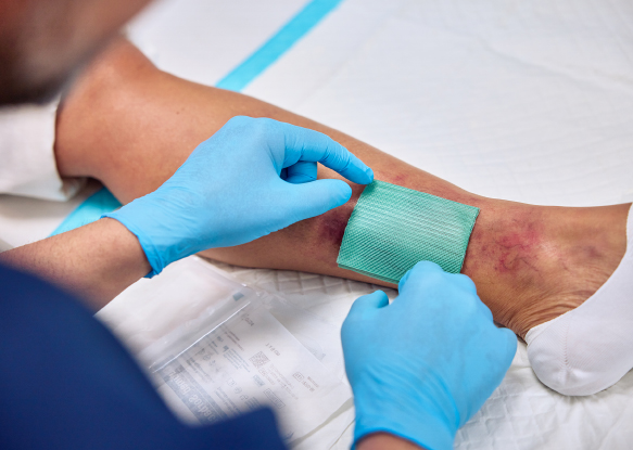Image showing a leg with an infected wound. Image showing a leg with an infected wound.